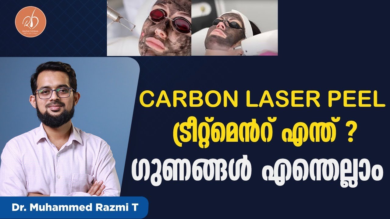 CARBON LASER PEEL ട്രീറ്റ്മെന്റ് എന്താണ് ?  ചെയ്താലുള്ള ഗുണങ്ങൾ  ഡോക്ടർ വിശദമായി വീഡിയോയിൽ പറയുന്നു