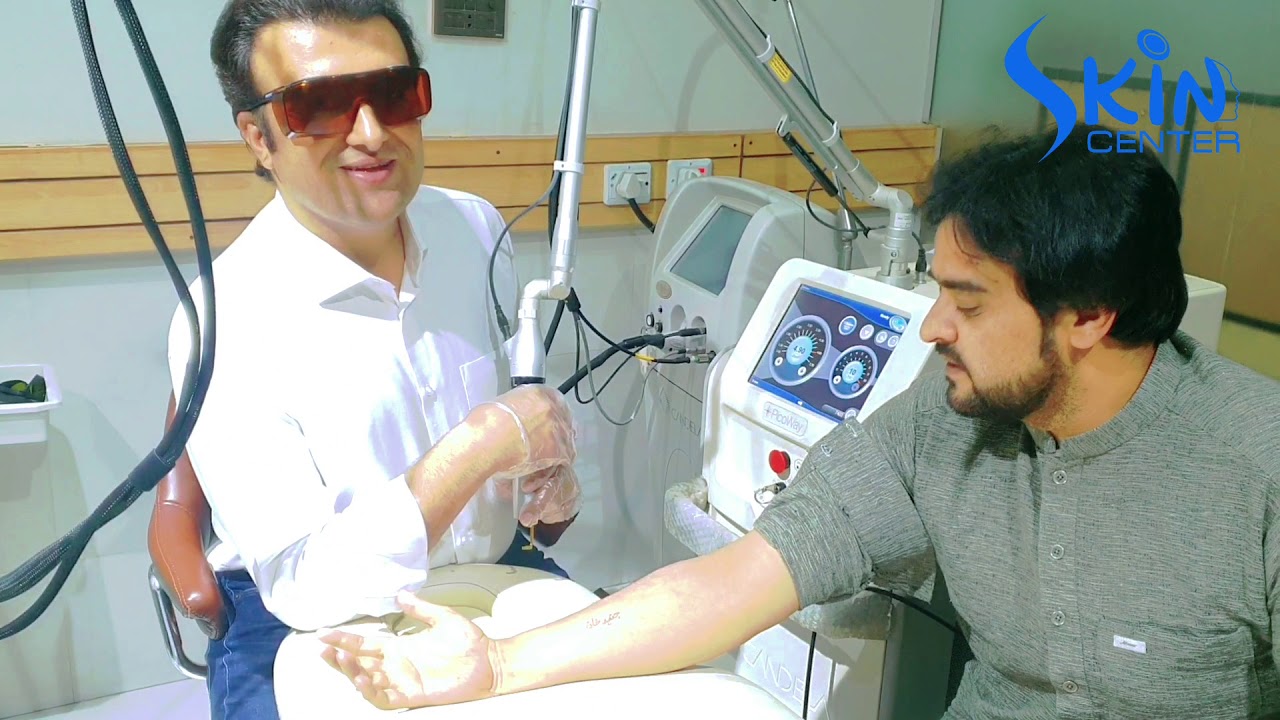 Tattoo removal by laser | Dr syed bilal shams | skin center