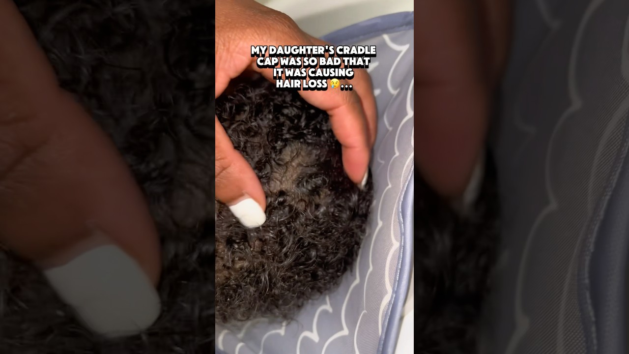 Cradle Cap and Hair Growth: Myth or Fact?
