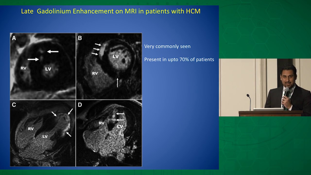 Ventricular Arrhythmias in Hypertrophic Cardiomyopathy