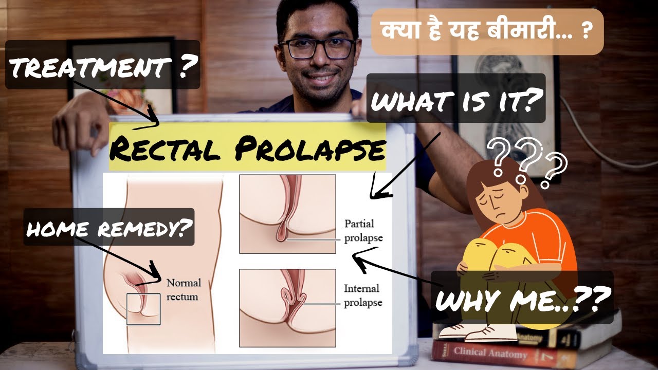 Rectal Prolapse - What Is It? Is It Serious? Home Remedy? | Dr Vishal Tomar | Open Consult