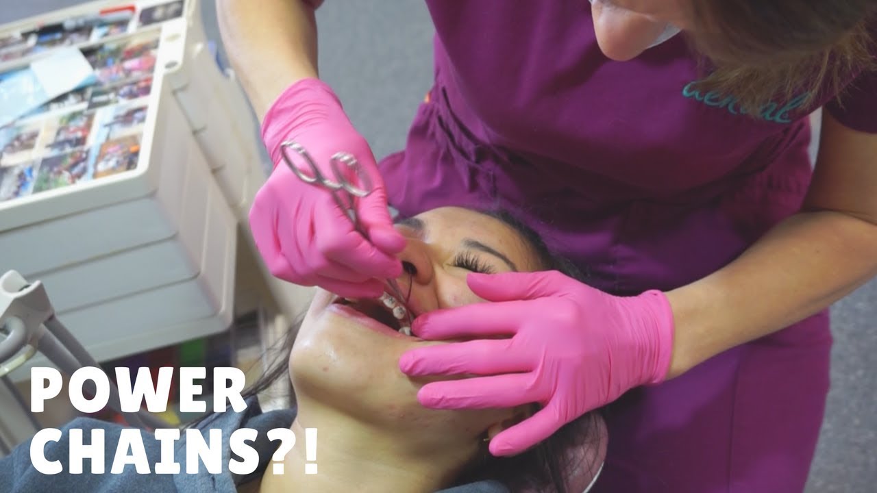BRACES VLOG