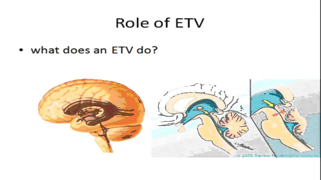 Your Questions About Hydrocephalus Answered - Is ETV the Preferred Treatment?