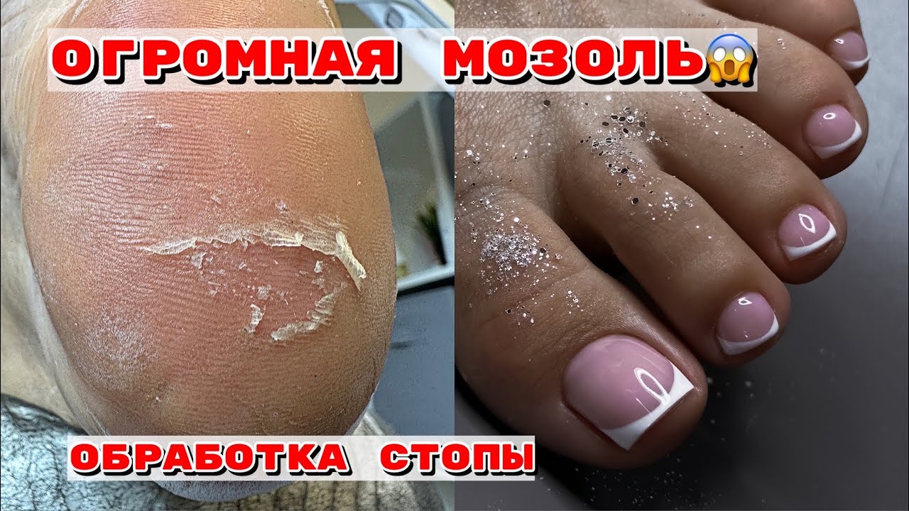 ОГРОМНАЯ мозоль😱на пятке/Педикюр френч😍