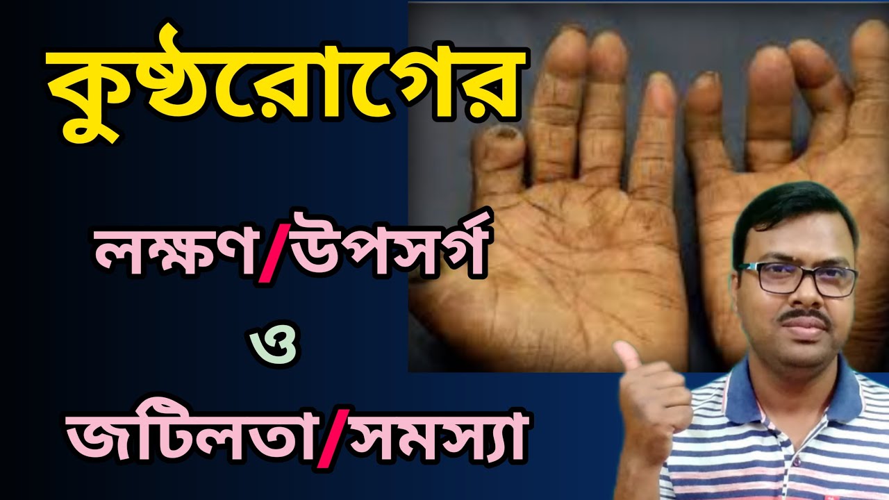 কুষ্ঠ রোগের লক্ষণ ও উপসর্গগুলি কি কি এবং কুষ্ঠ রোগের জটিলতা। Leprosy Symptoms or Leprosy in Bengali