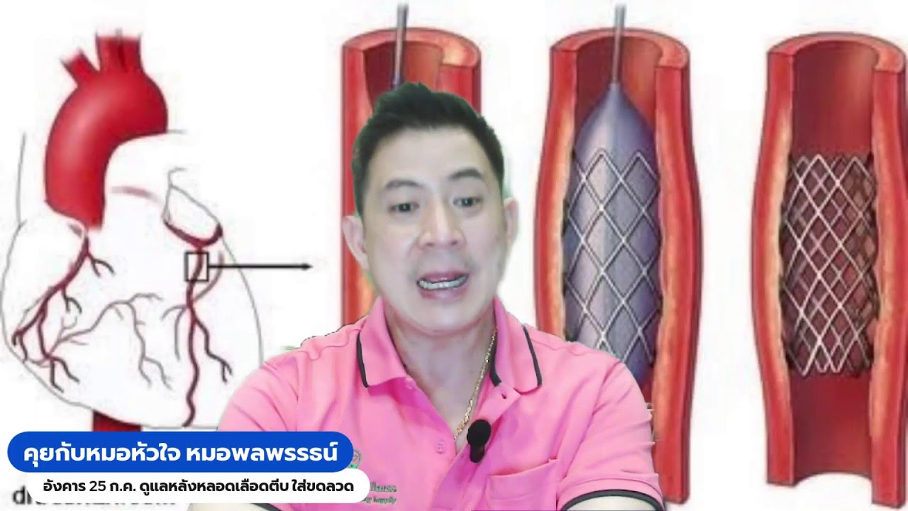 ดูแลหลังหลอดหัวใจตีบ หลังใส่ขดลวดอย่างไร ให้ชีวิตดีกว่าเดิม Live คุยกับหมอหัวใจ อังคาร 25 ก.ค.66