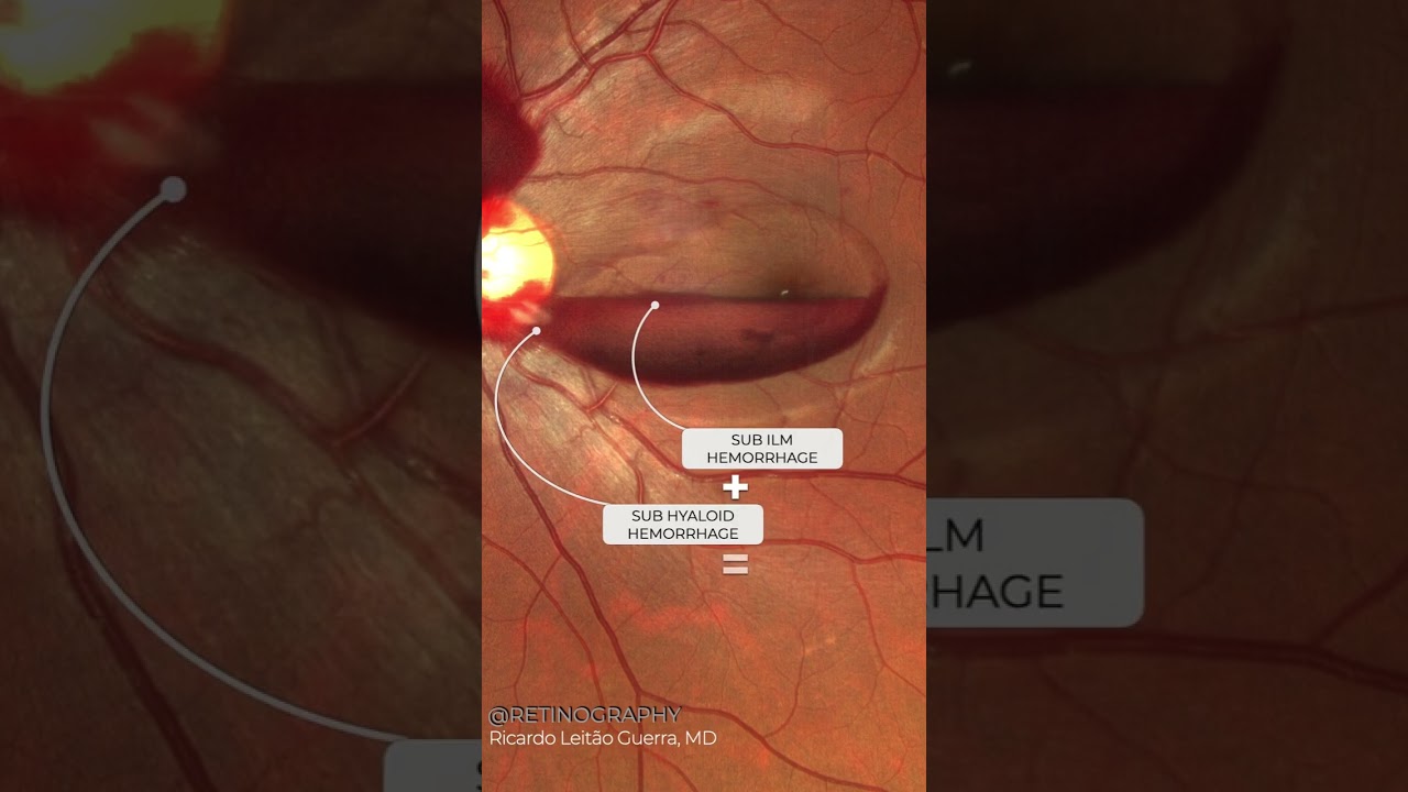 Valsalva retinopathy after 🚽💩😅 #retina #oftalmo #ophthalmology #oftalmologia #oftalmolog&iacute;a #ophtalm