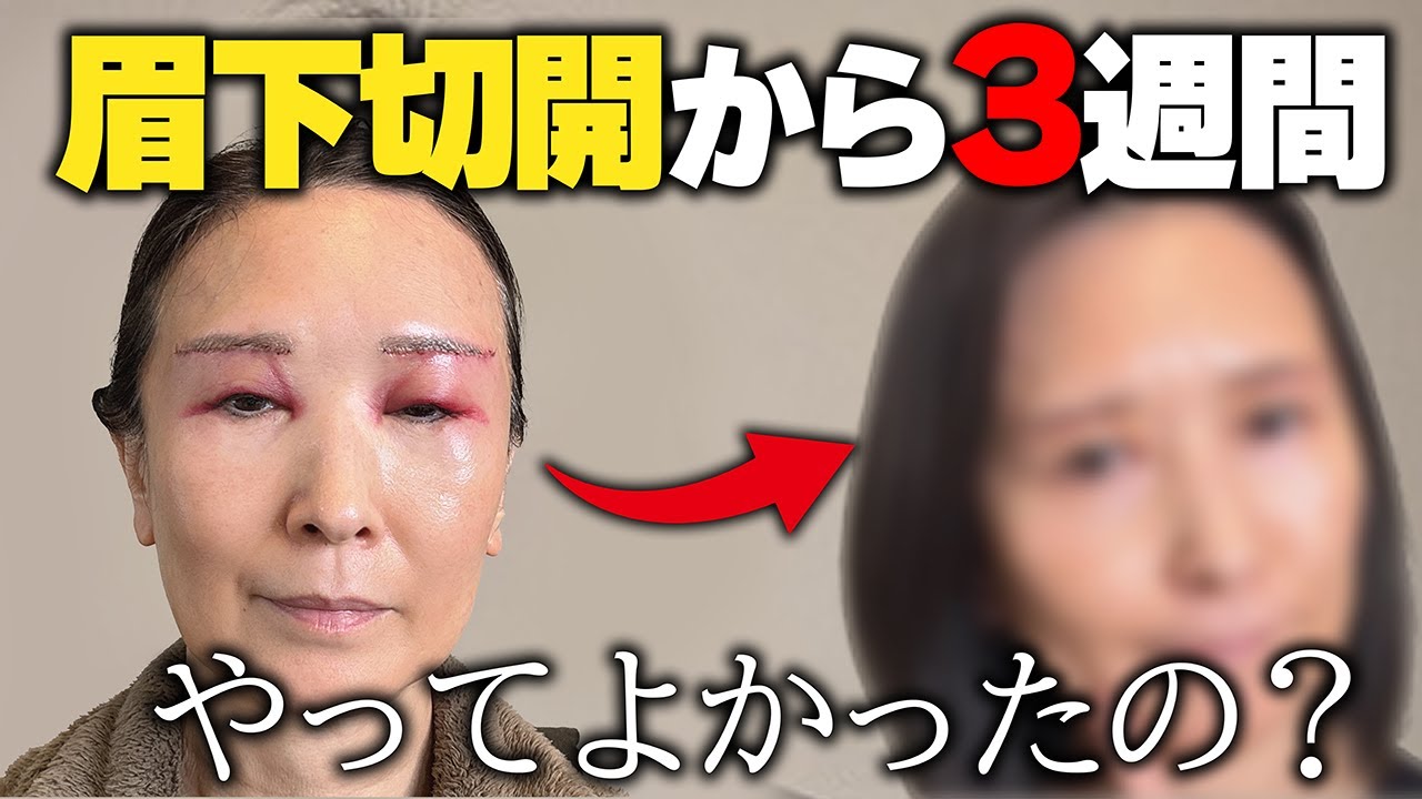 眉下切開手術を受けてから３週間が経ちました。