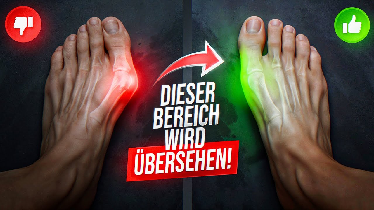 3 Übungen gegen Hallux Valgus | Ursache & Lösung (Ohne OP)