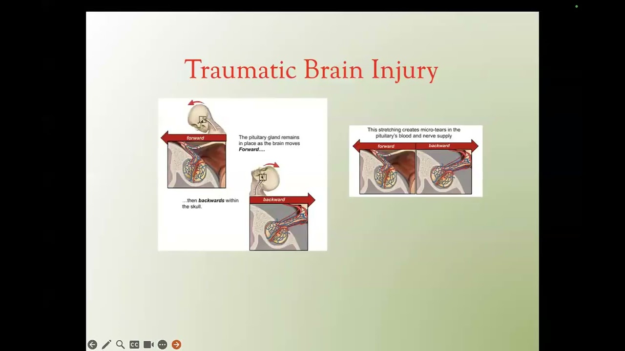 Dr. Theodore C. Friedman's Webinar on Optimal Replacement for Hypopituitarism and Sheehan’s