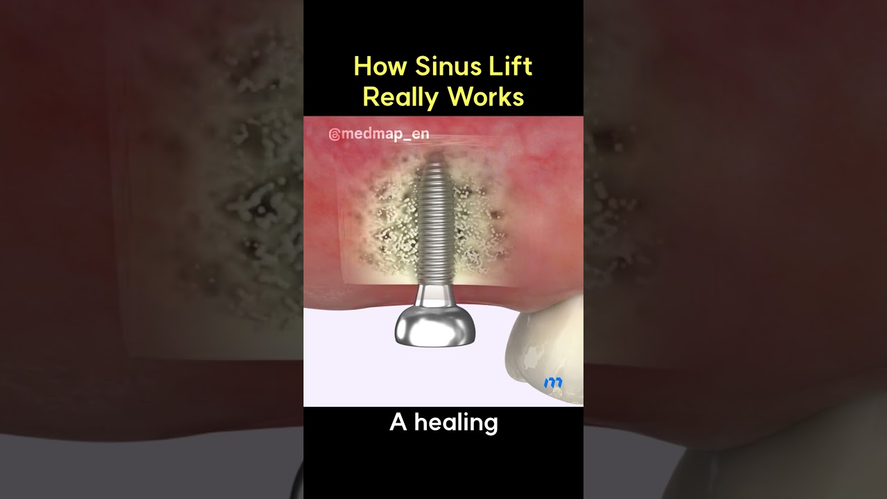 How Sinus Lift Really Works