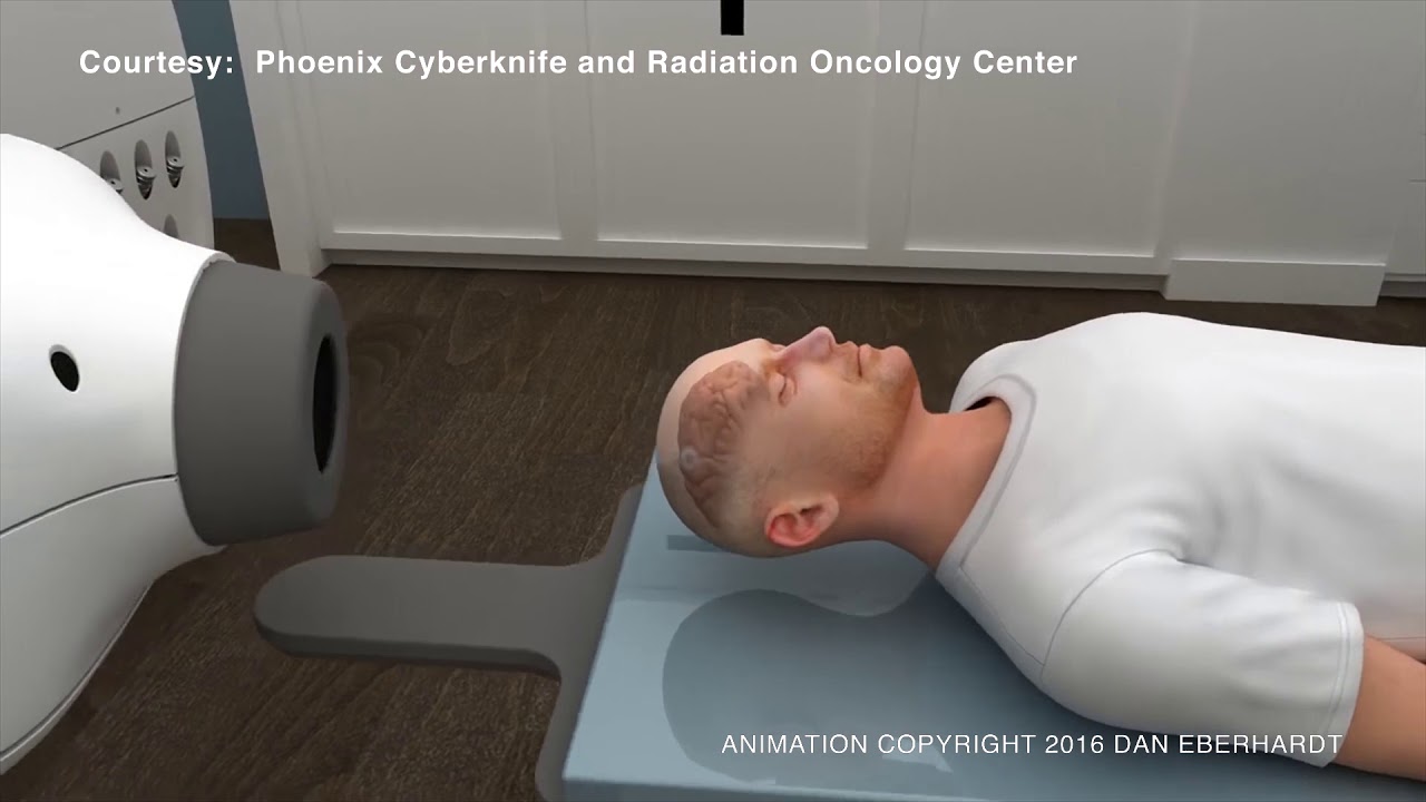 CyberKnife® Robotic Radiosurgery for Inoperable Brain Tumors
