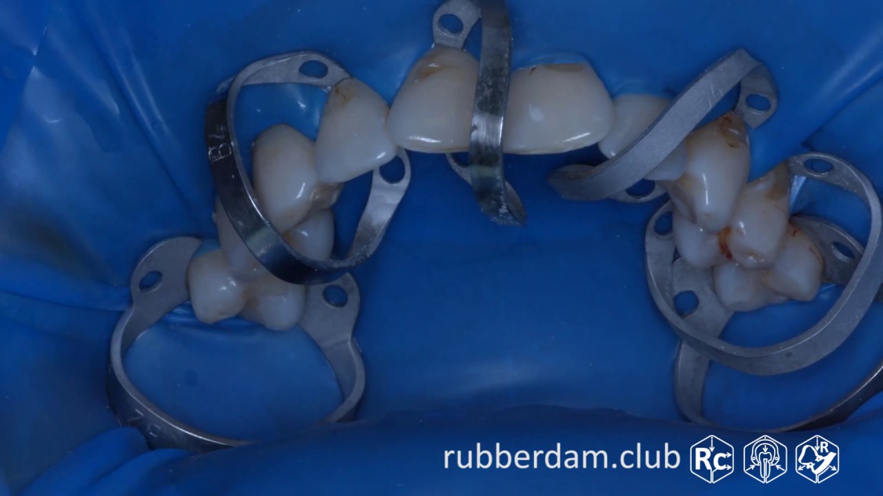 Установка системы раббердам 1.5 - 2.5 (Rubberdam 158 Brinker B4 TorVM 4K) Ч. 1 из 5 - Апокин А.Д.