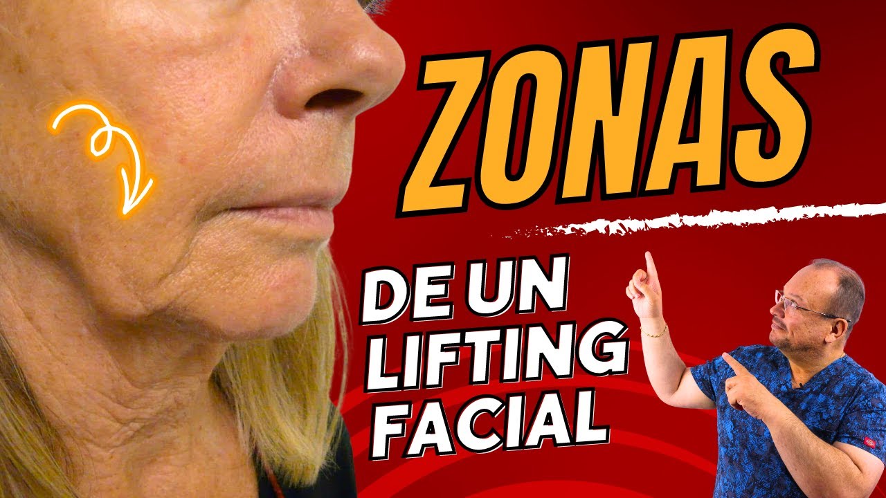 Zonas Del Rostro Para el LIFTING Facial 💕  Tercio Inferior, Medio y Superior 🚨 Dr Alberto Calvo