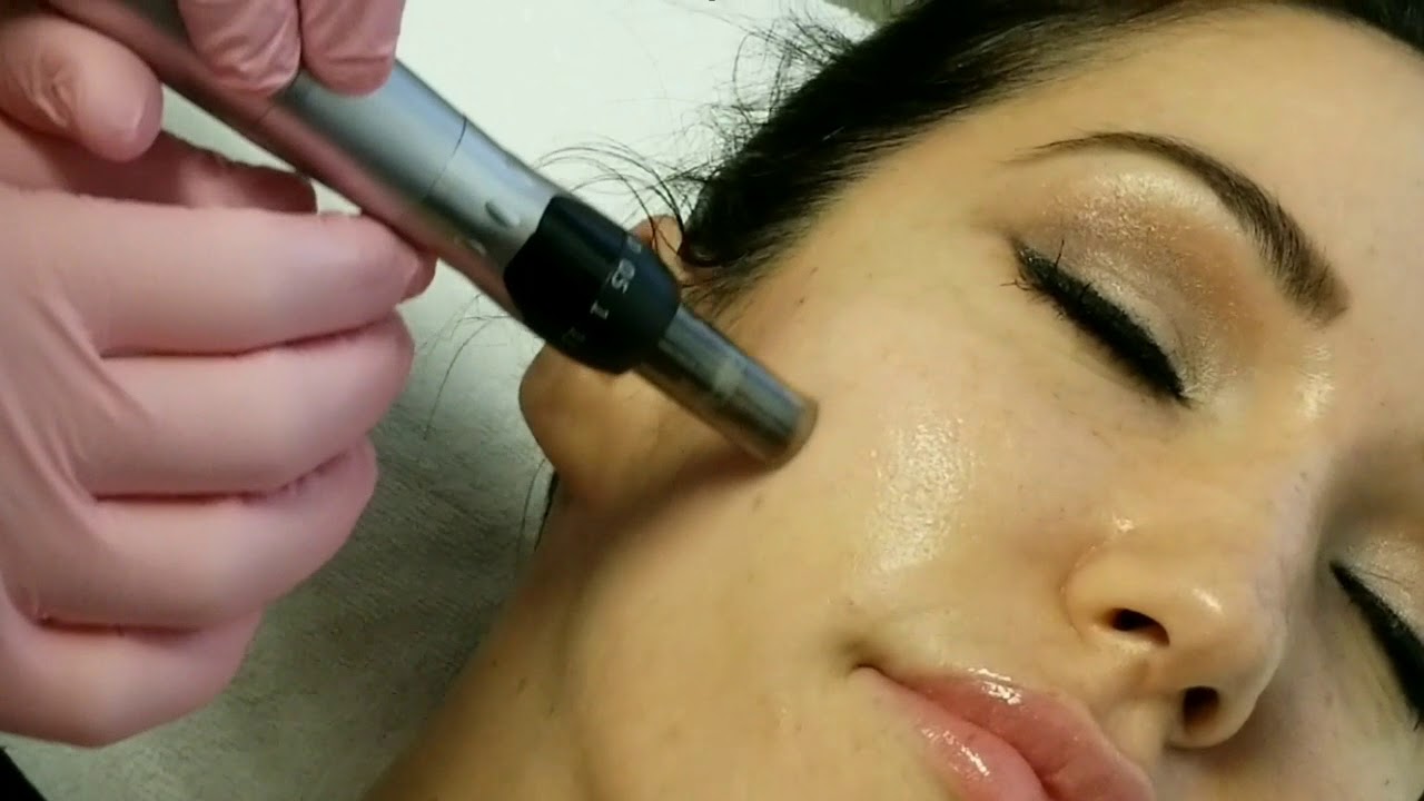 COSMOPen Microneedling at Mystique Medical Spa