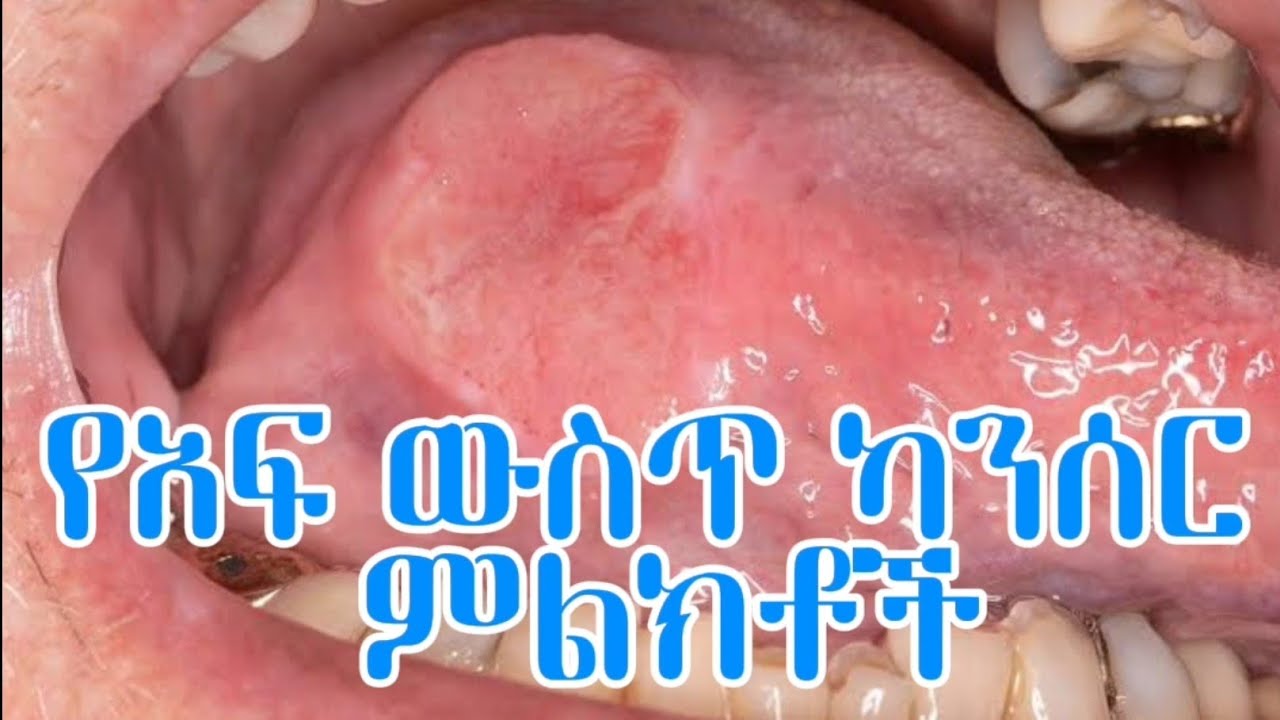 የአፍውስጥ ካንሰር የመጀመሪያ ምልክቶች