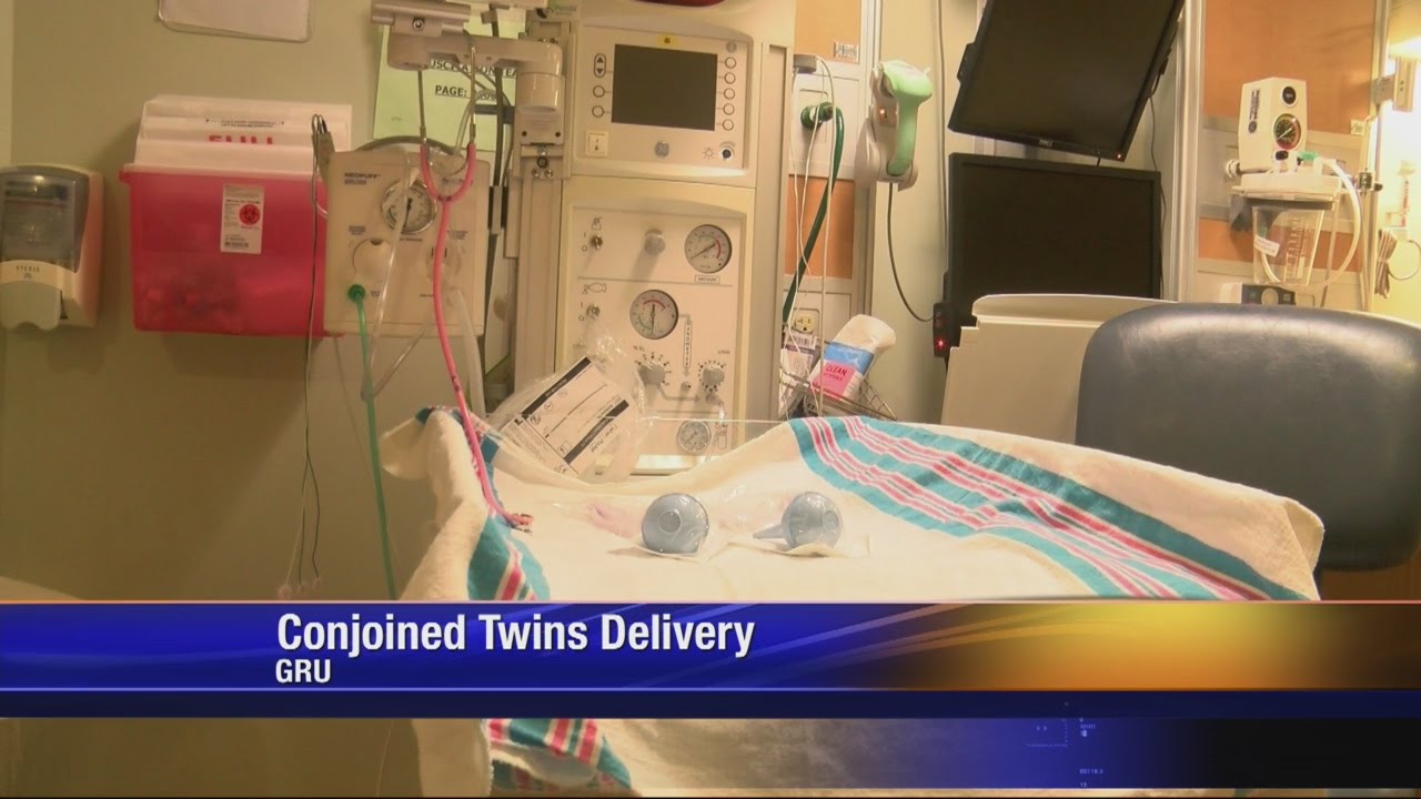 Conjoined Twin Boys Born At GRMC