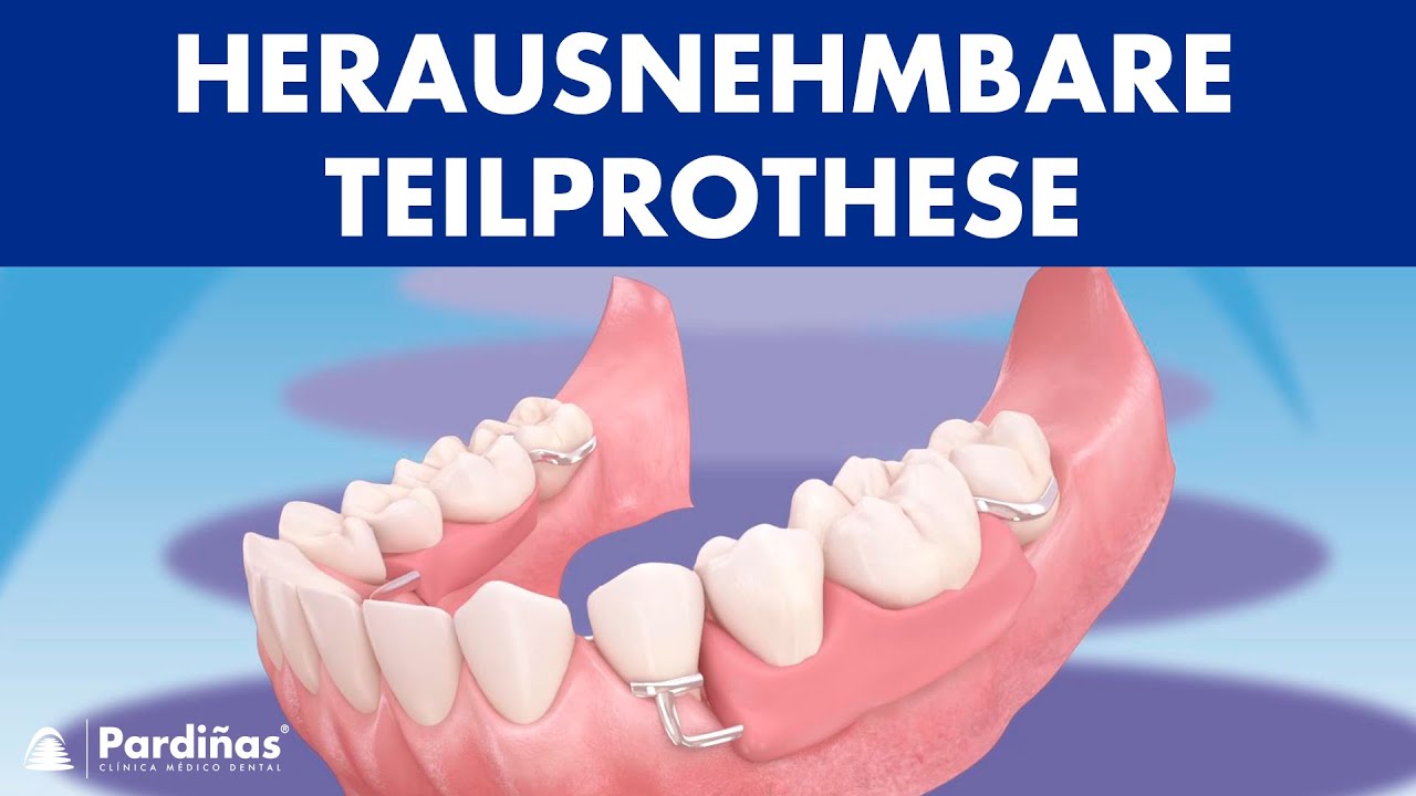 Herausnehmbare Teilprothese ©