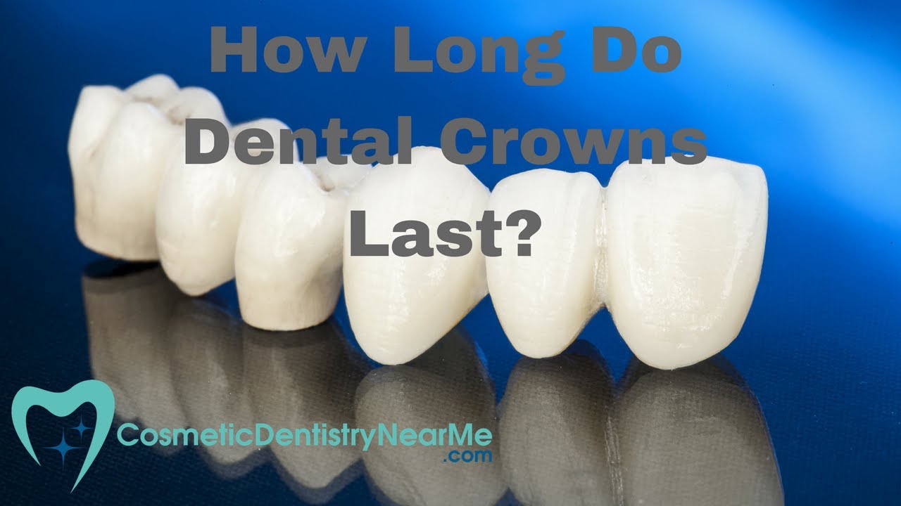 How Long do Dental Crowns Last?