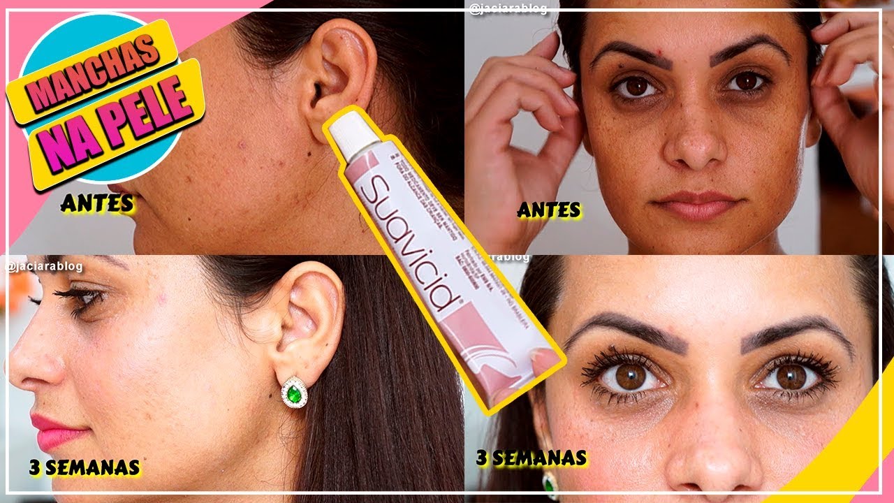 3 SEMANAS USANDO SUAVICID COMO ESTOU USANDO ANTES E DEPOIS