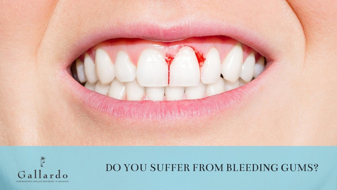 Do you suffer from bleeding gums?