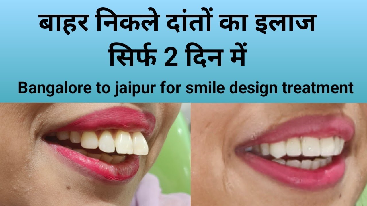बाहर निकले दांतों का इलाज सिर्फ 2 दिन//Smile design treatment se badle apni muskaan// Smile makeover