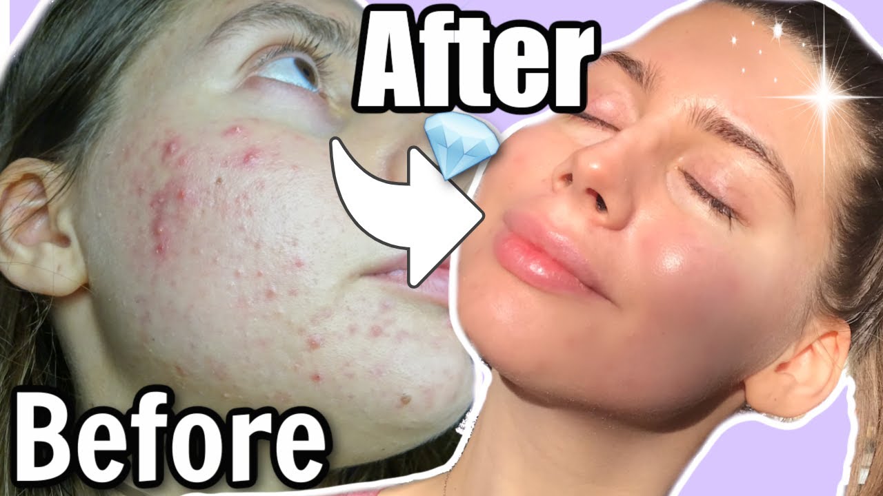 How I GOT RID of TEXTURED SKIN, and WHAT YOU SHOULD KNOW!!