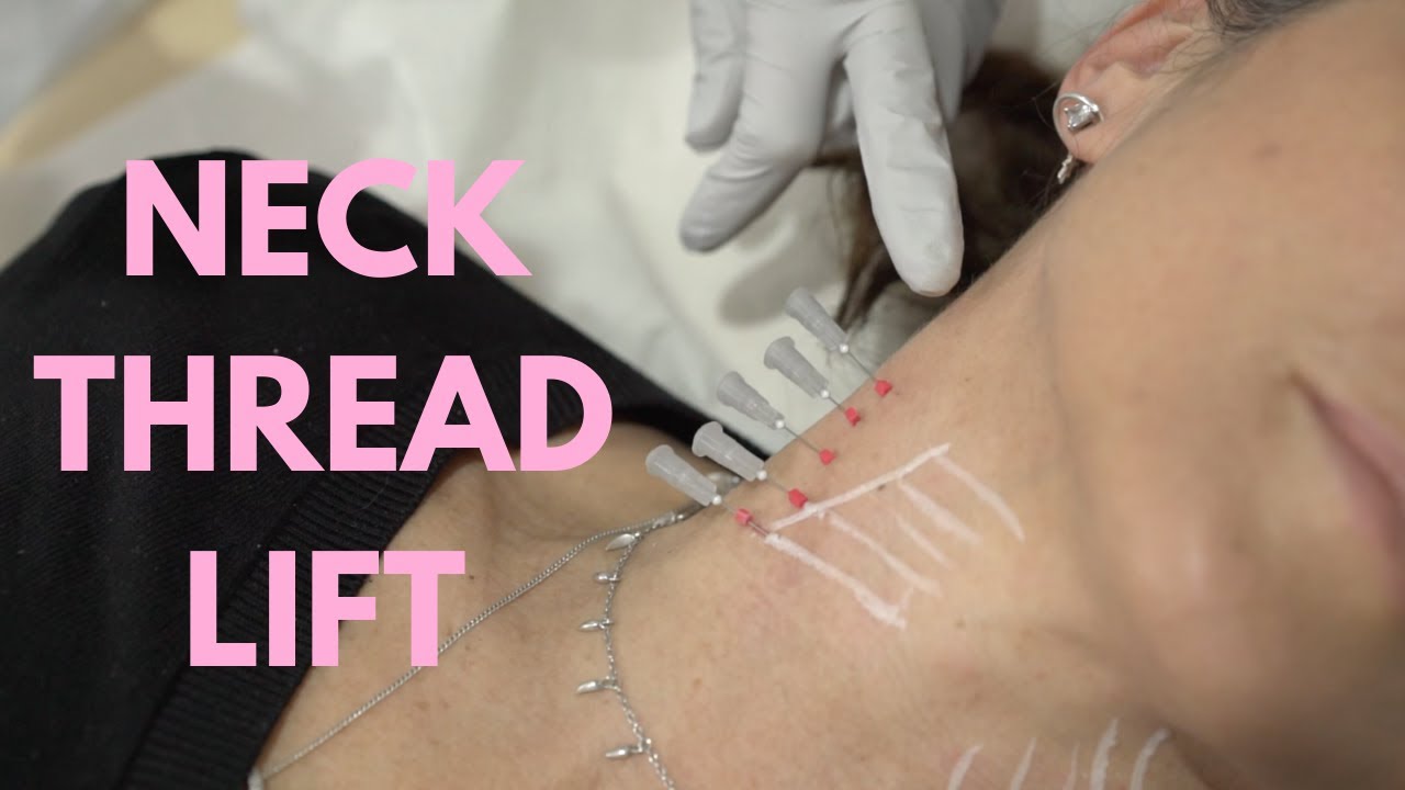 Neck Thread Lift Procedure by Dr Nina Bal 💕 PDO Neck Thread Lift Before and After