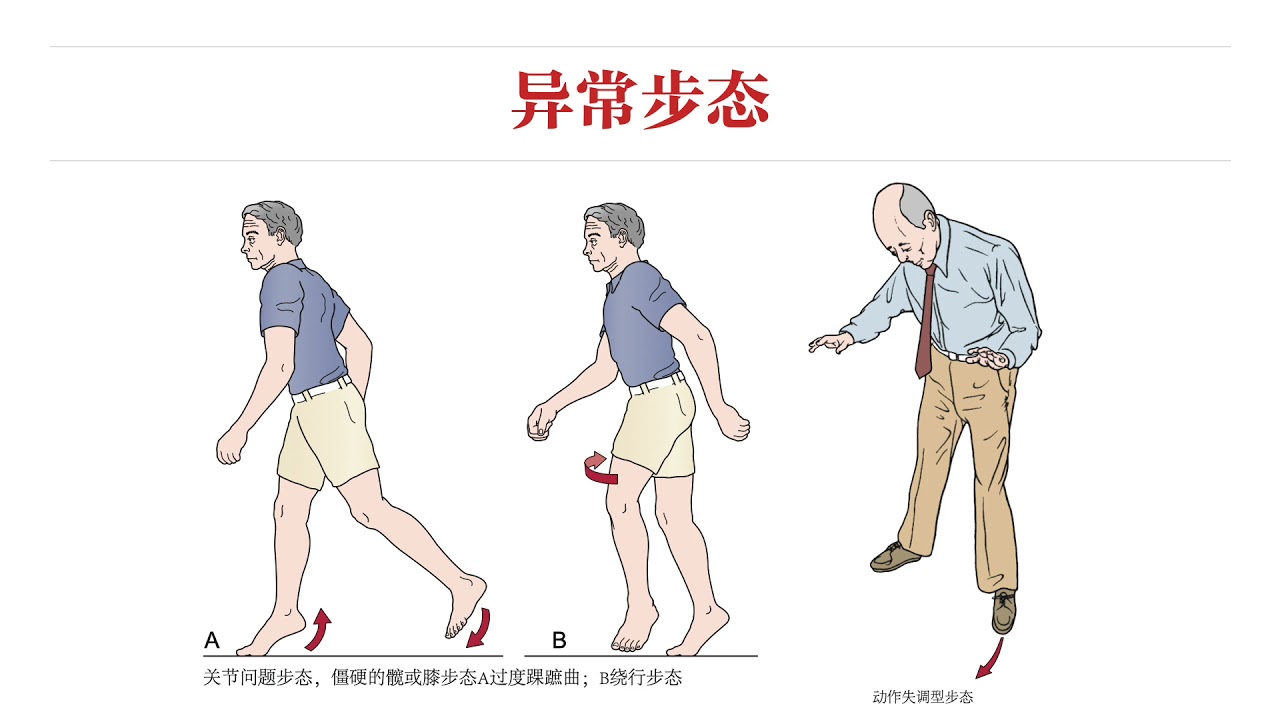 【骨科物理治疗评估】14步态评估｜异常步态