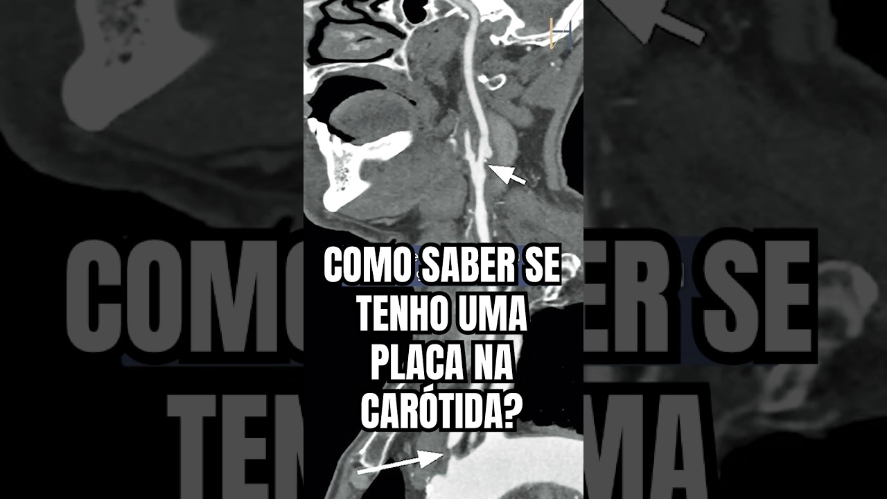🔬 DIAGN&Oacute;STICO DAS PLACAS NA CAR&Oacute;TIDA: COMO FUNCIONA? | S&Eacute;RIE ESTENOSE DE CAR&Oacute;TIDA Ep. 2