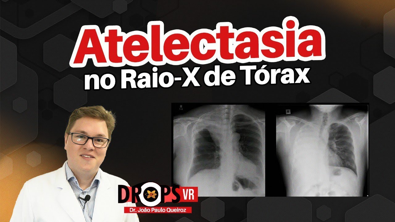 ATELECTASIA - APRENDA A RECONHECER NO RAIO-X DE T&Oacute;RAX I VOC&Ecirc; RADIOLOGISTA