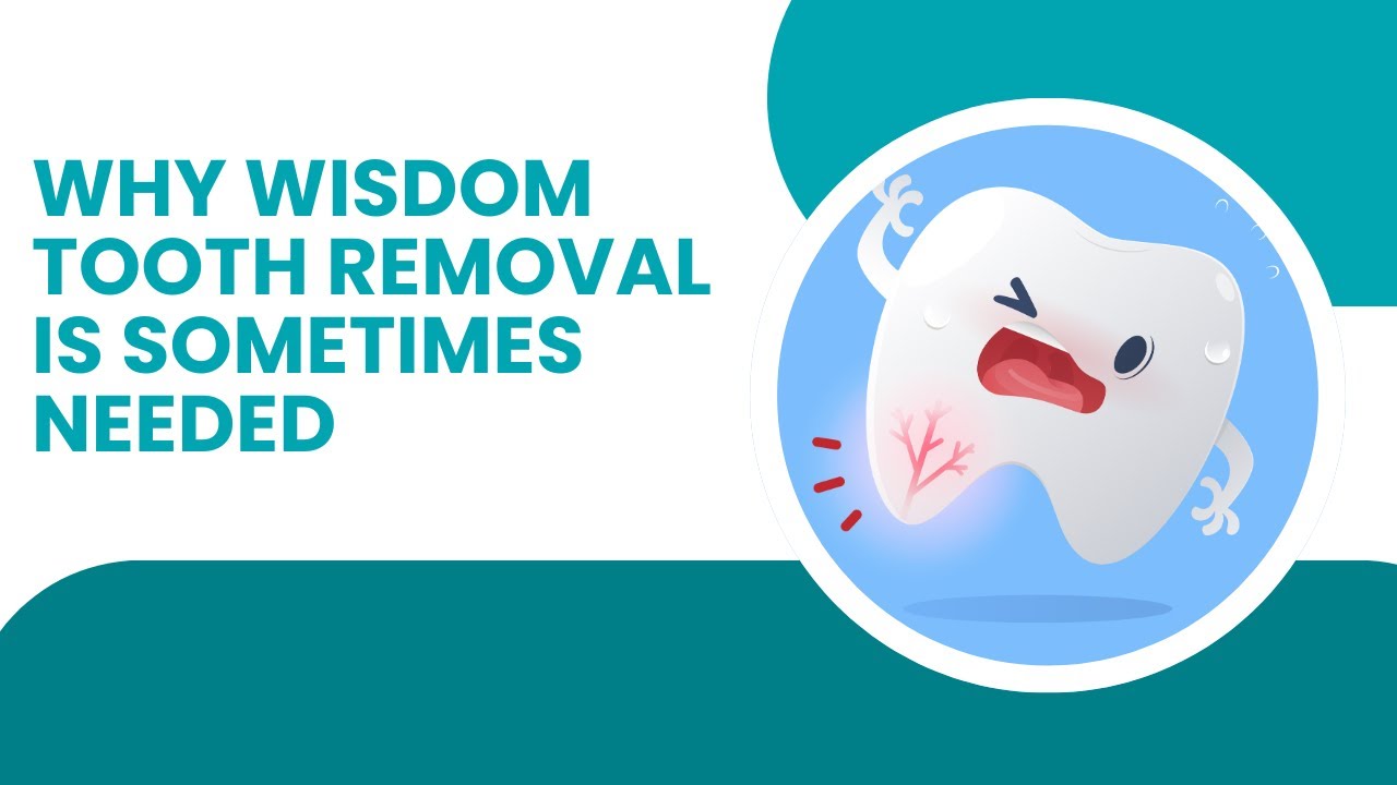Why Wisdom Tooth Removal is Sometimes Needed | Shrouf Dental House