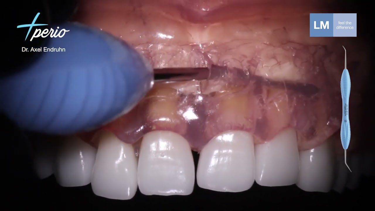 How to use LM&trade; Papilla Remota - Periosteal and Micro Papilla Elevator