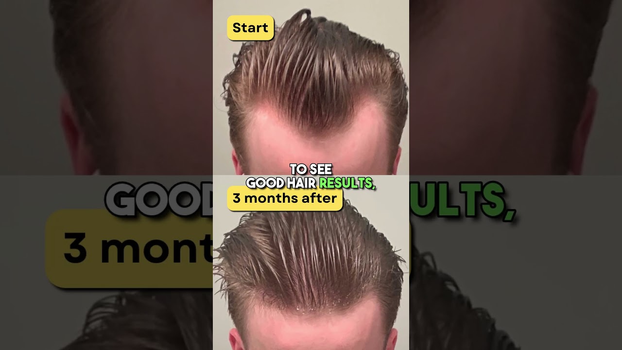 Microneedling your scalp to regrow hair