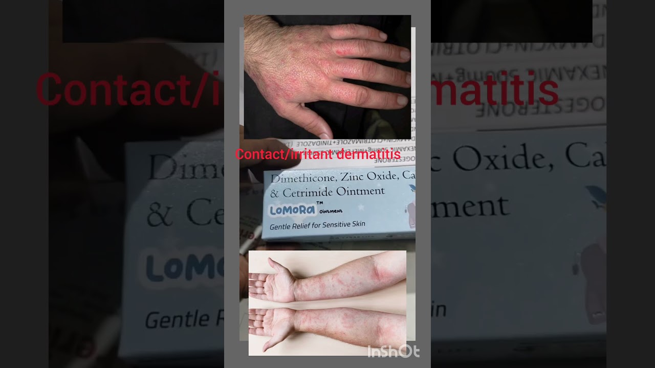 Lomora Ointment use for nappy, diaper rashes,contact/irritant dermatitis,Bed sores.