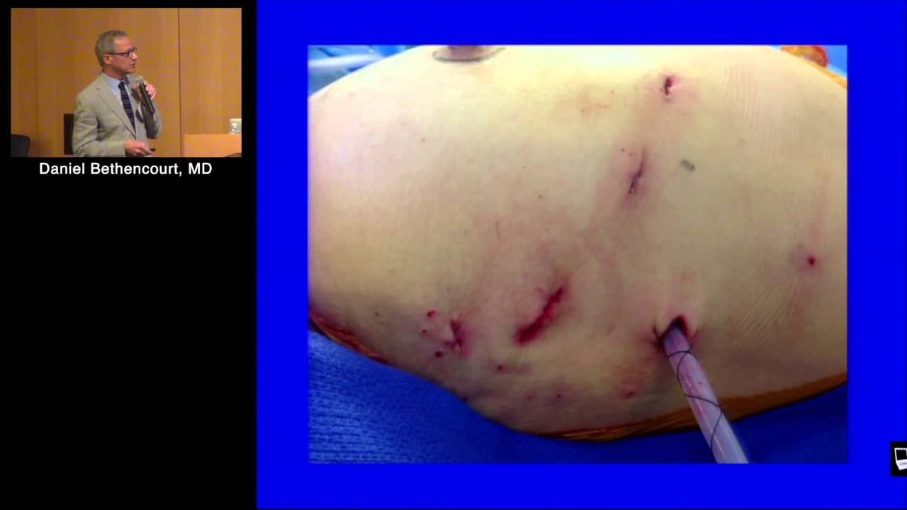 Robotic MVR (Daniel Bethencourt, MD)