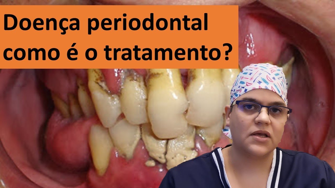 Doença periodontal tem cura? qual o tratamento?| Dra Bianca Rosa | Clínica Bianca Rosa