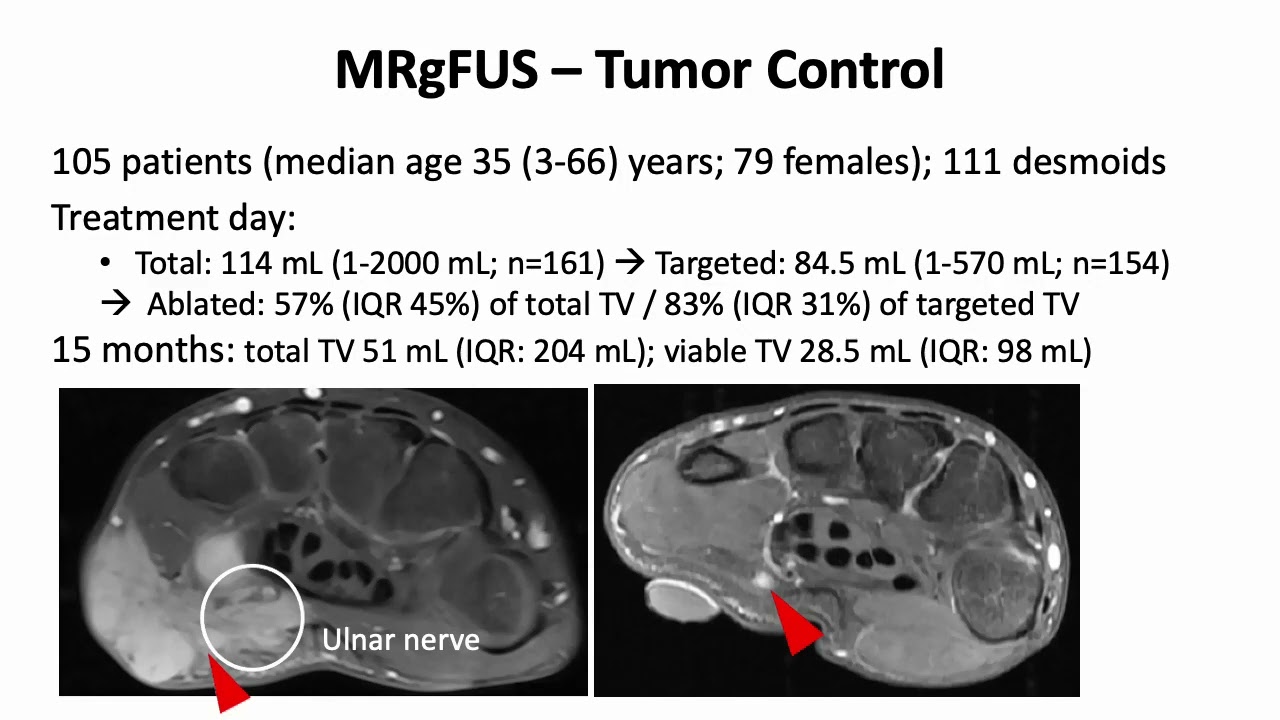 Daniel Düx: MRgFUS in Patients with Extra-Abdominal Desmoid Tumors