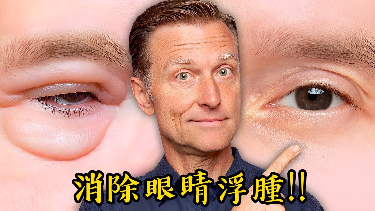眼睛浮腫、眼皮腫怎麼辦？(2024年新影片),自然療法,柏格醫生 Dr Berg