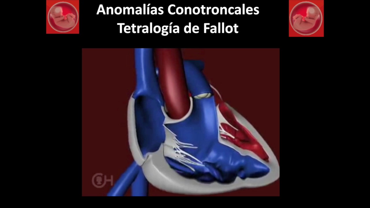 Tetralog&iacute;a de Fallot (Demo del Curso Avanzado)