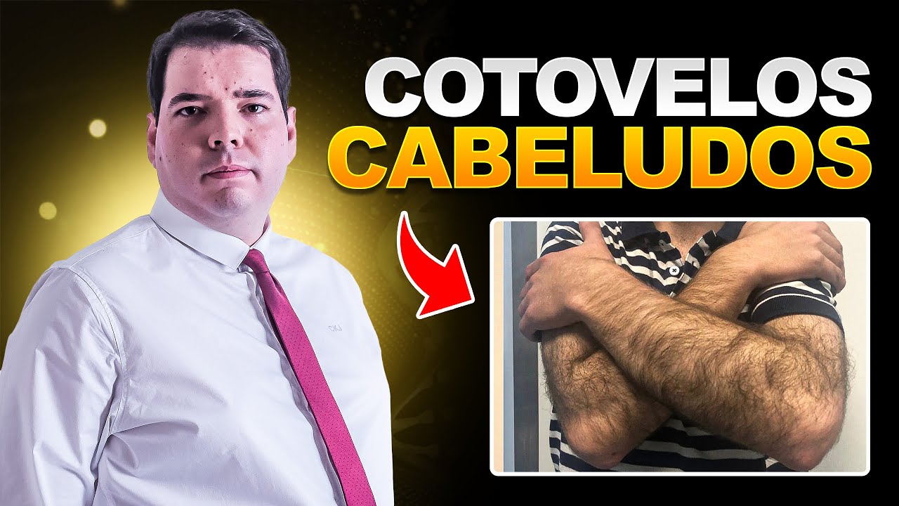 Síndrome de Wiedemann-Steiner - Cotovelos Cabeludos