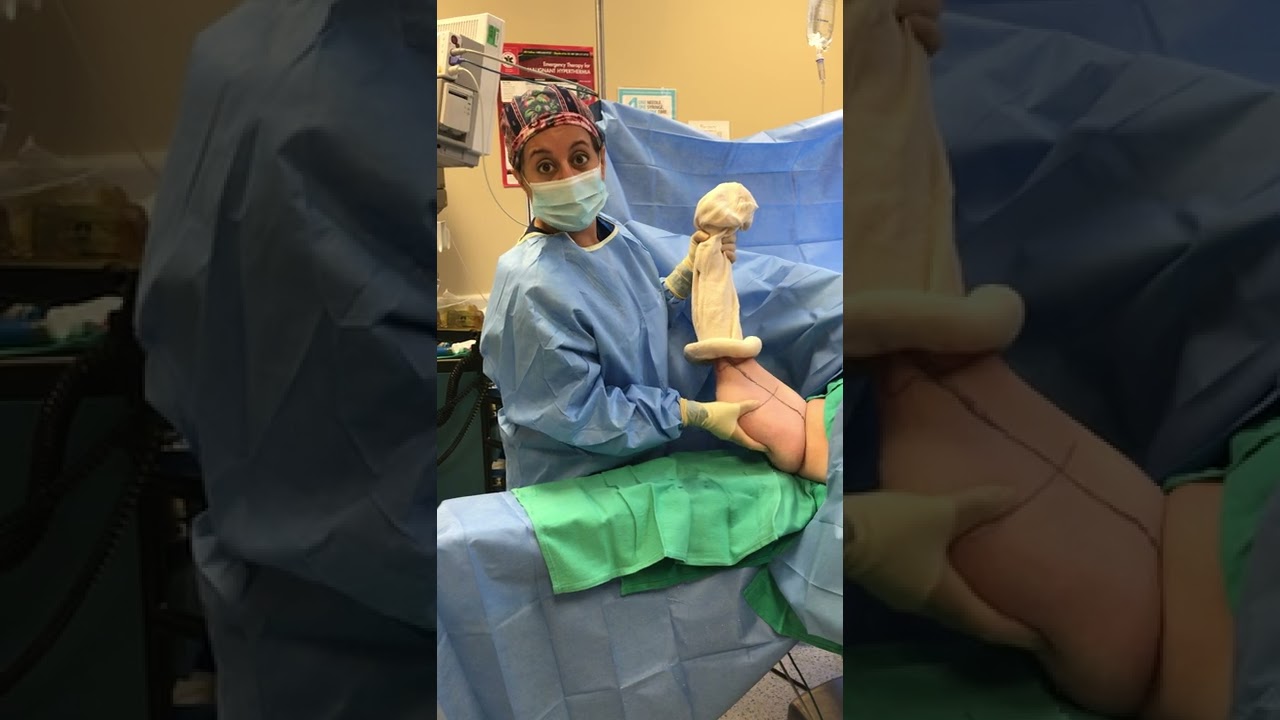 Brachioplasty by Afifi MD, FACS, Double Board Certified Plastic Surgeon, Newport Beach
