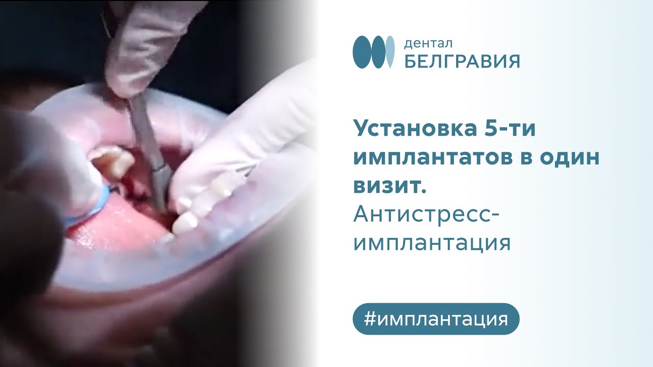 🦷 Установка 5-ти имплантатов в один визит. Антистресс-имплантация