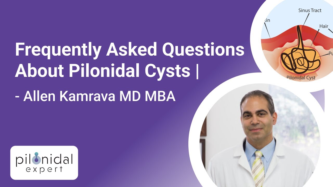 Frequently Asked Questions About Pilonidal Cysts | Pilonidal Expert