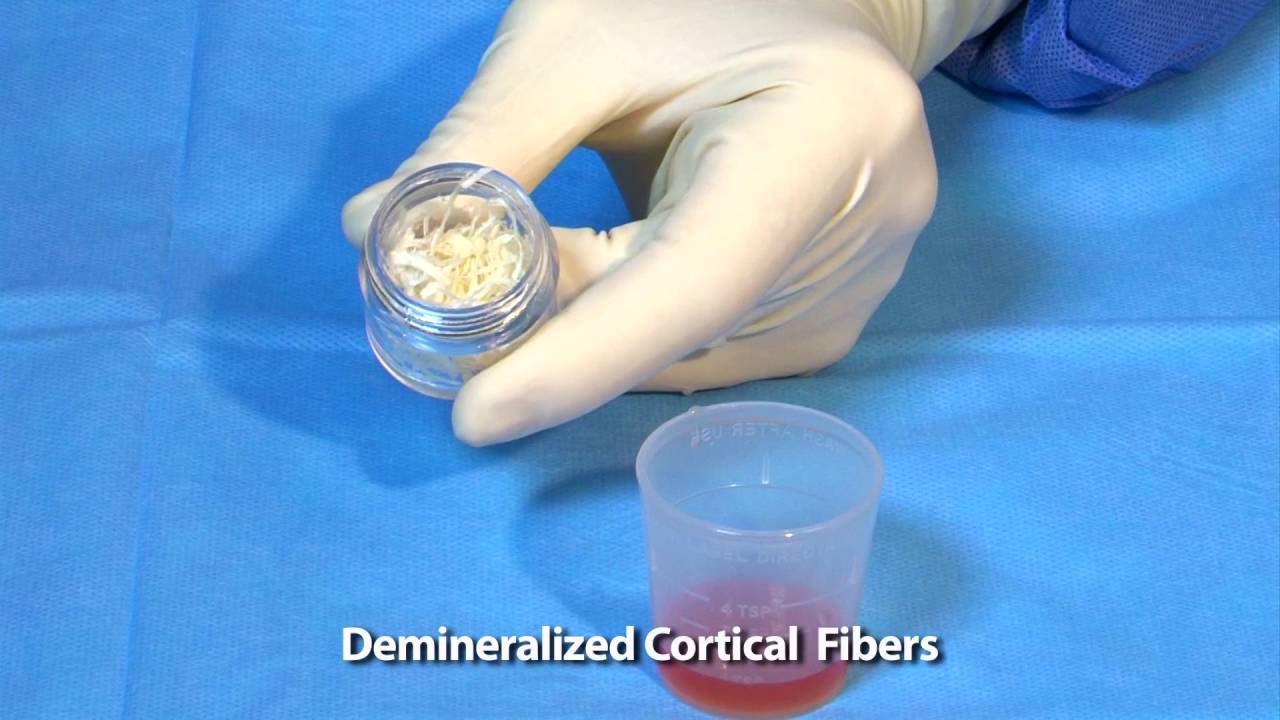 FlexiGraft Demineralized Cancellous Sponges and Cortical Fibers