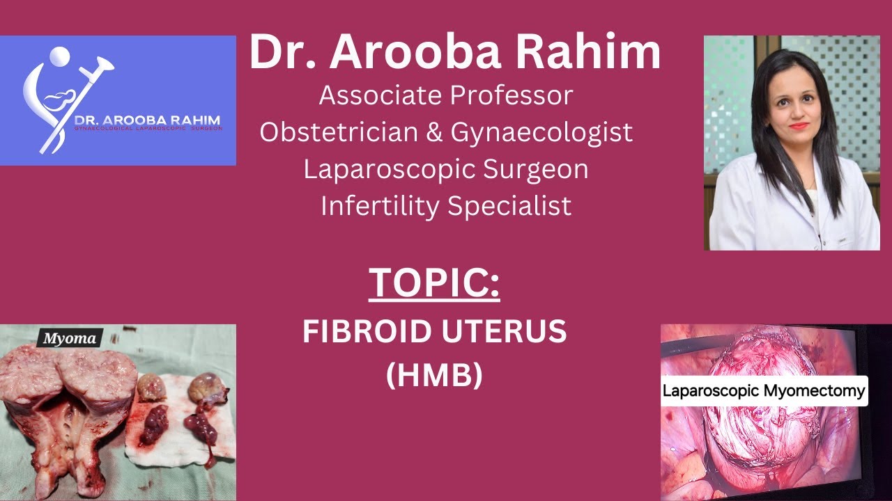 FIBROID UTERUS (HMB)