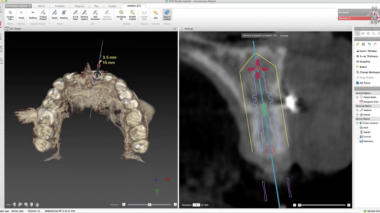 Placing a dental implant in DTX Implant Studio