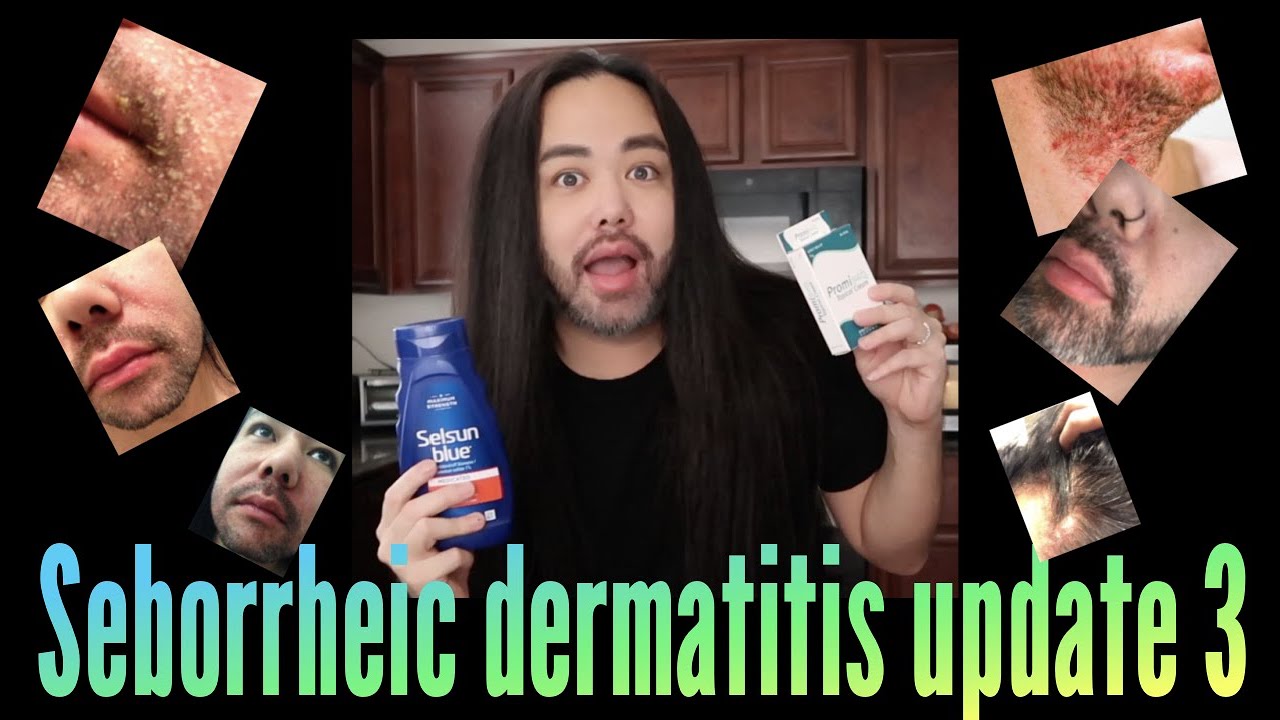 Seborrheic Dermatitis | Update 3 |