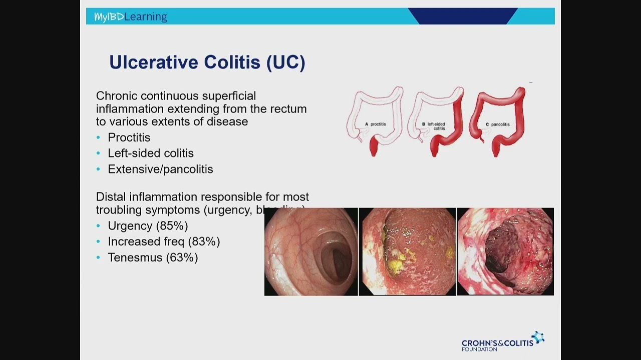 IBD 101: An Overview of Inflammatory Bowel Disease