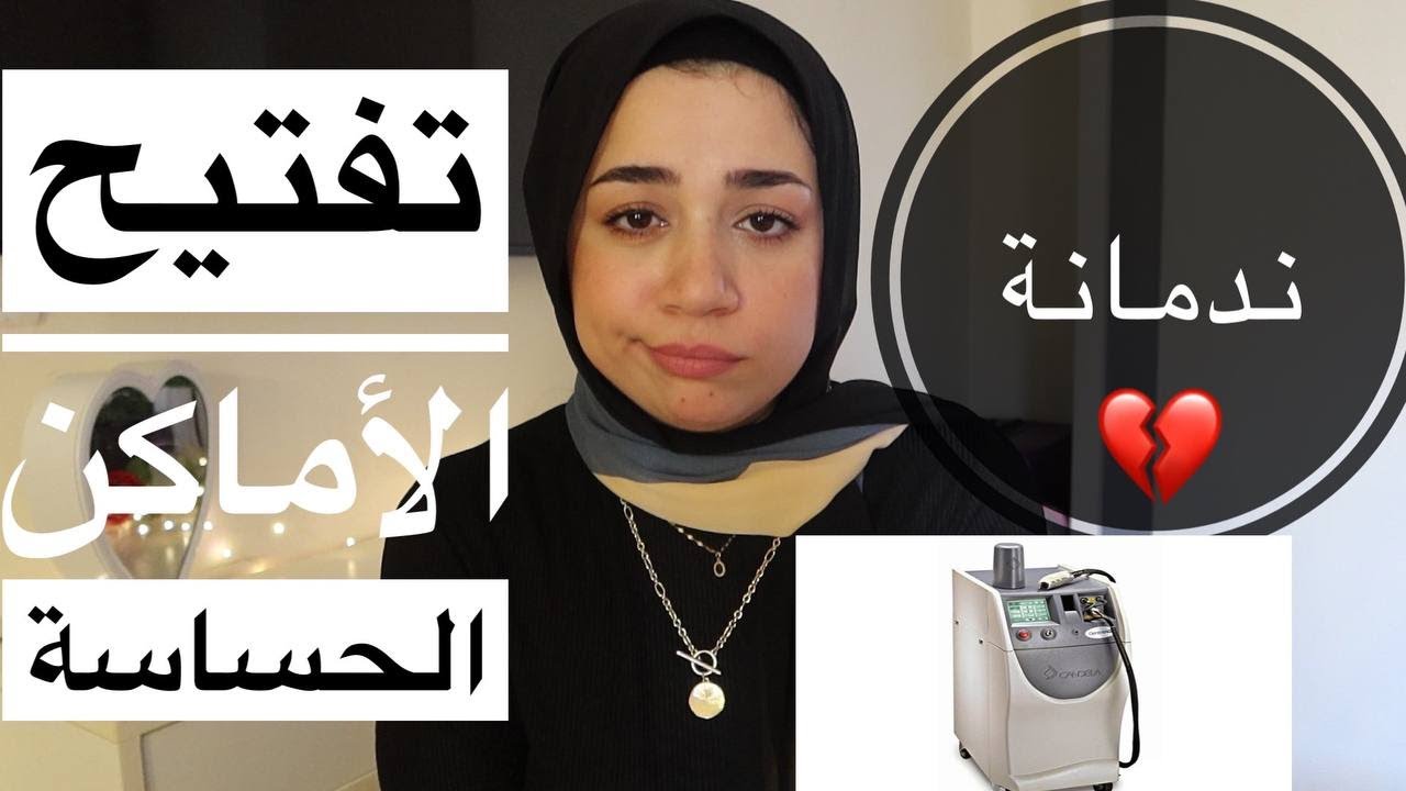 وفروا فلوسكوا الليزر مش بيشيل الشعر نهائياً ولا حاجة (تجربتي الكاملة مع إزالة الشعر بالليزر بعد سنة)